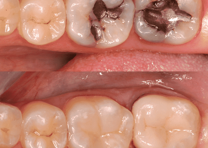 png-transparent-tooth-dental-restoration-inlays-and-onlays-crown-dental-composite-cosmetic-treatment-dentistry-lip-veneer